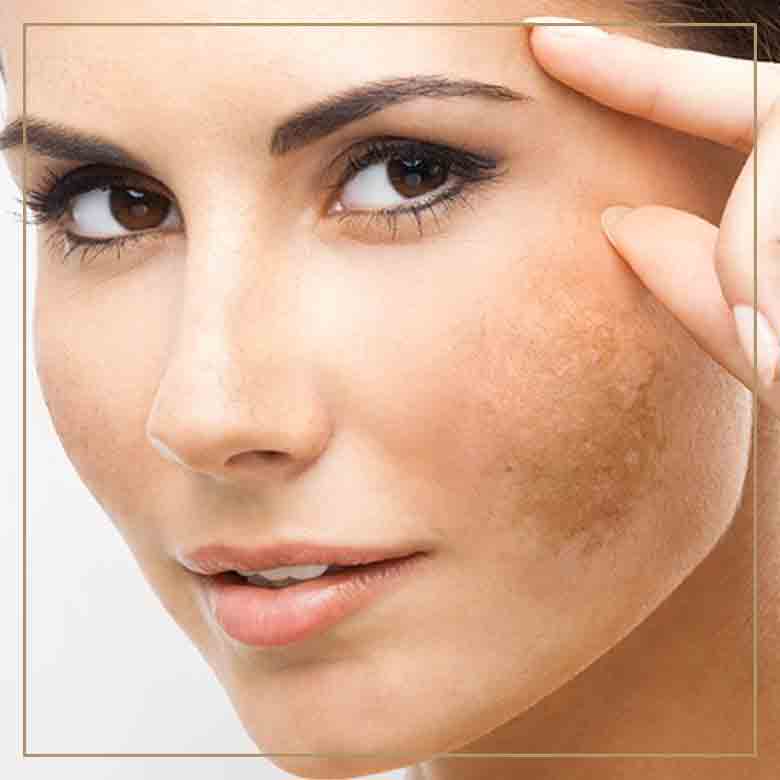 melasma-tratamento-dermatologista-bh